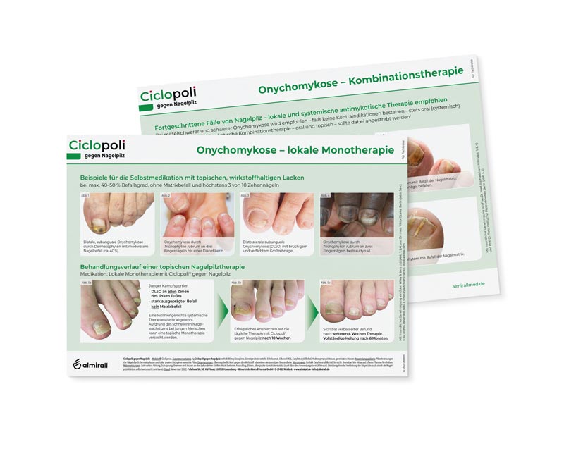 ciclopoli onychomykose uebersichtstafel